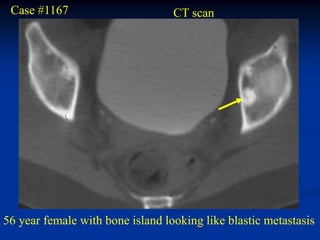 Case #1167                       CT scan




56 year female with bone island looking like blastic metastasis
 