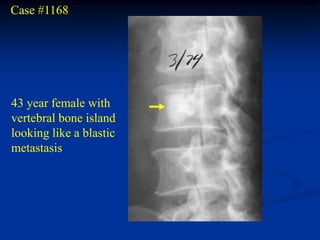 Case #1168




43 year female with
vertebral bone island
looking like a blastic
metastasis
 