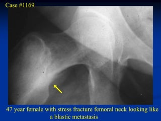 Case #1169




47 year female with stress fracture femoral neck looking like
                a blastic metastasis
 
