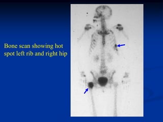 Bone scan showing hot
spot left rib and right hip
 