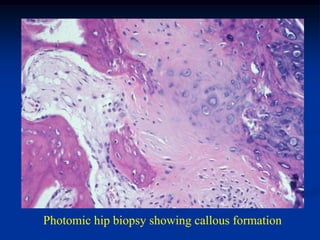 Photomic hip biopsy showing callous formation
 