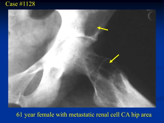 Case #1128




   61 year female with metastatic renal cell CA hip area
 