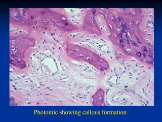 Photomic showing callous formation
 
