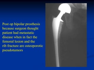 Post op bipolar prosthesis
because surgeon thought
patient had metastatic
disease when in fact the
femoral lesion and the
rib fracture are osteoporotic
pseudotumors
 