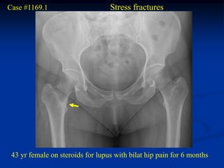 Case #1169.1                      Stress fractures




 43 yr female on steroids for lupus with bilat hip pain for 6 months
 