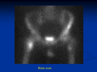 Bone scan
 
