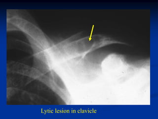 Lytic lesion in clavicle
 