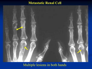 Metastatic Renal Cell




Multiple lesions in both hands
 