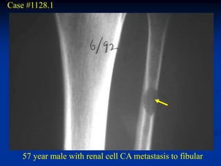 Case #1128.1




   57 year male with renal cell CA metastasis to fibular
 