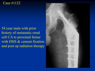 Case #1122




54 year male with prior
history of metastatic renal
cell CA to proximal femur
with DHS & cement fixation
and post op radiation therapy
 