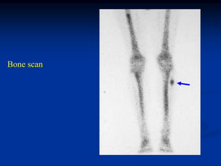 Bone scan
 