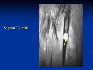 Sagittal T-2 MRI
 