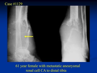 Case #1129




      61 year female with metastatic aneurysmal
            renal cell CA to distal tibia
 