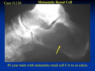 Case #1130            Metastatic Renal Cell




 45 year male with metastatic renal cell CA to os calcis
 