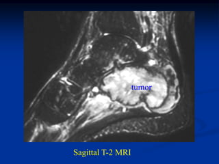 tumor




Sagittal T-2 MRI
 