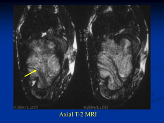 Axial T-2 MRI
 