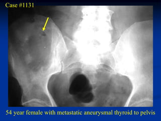 Case #1131




54 year female with metastatic aneurysmal thyroid to pelvis
 