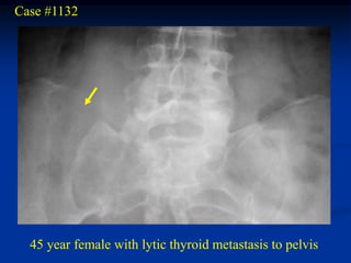 Case #1132




  45 year female with lytic thyroid metastasis to pelvis
 