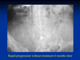 tumor                         tumor




Rapid progression without treatment 6 months later
 