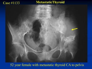 Case #1133           MetastaticThyroid




    52 year female with metastatic thyroid CA to pelvis
 
