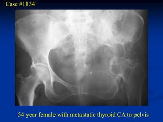 Case #1134




    54 year female with metastatic thyroid CA to pelvis
 