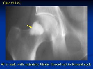 Case #1135




48 yr male with metastatic blastic thyroid met to femoral neck
 