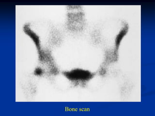 Bone scan
 