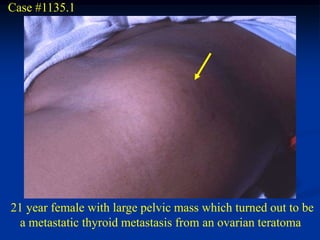 Case #1135.1




21 year female with large pelvic mass which turned out to be
  a metastatic thyroid metastasis from an ovarian teratoma
 