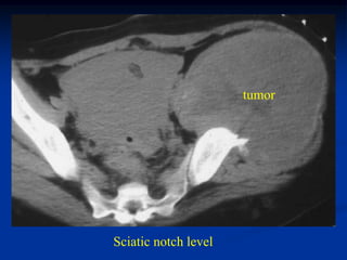 tumor




Sciatic notch level
 
