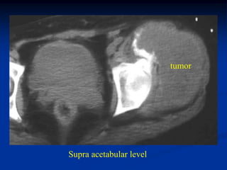tumor




Supra acetabular level
 