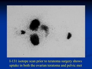 I-131 isotope scan prior to teratoma surgery shows
uptake in both the ovarian teratoma and pelvic met
 