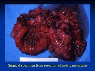 Surgical specimen from resection of pelvic metastasis
 