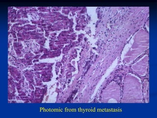 Photomic from thyroid metastasis
 