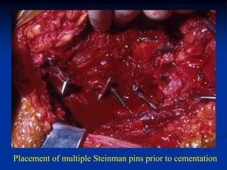 Placement of multiple Steinman pins prior to cementation
 