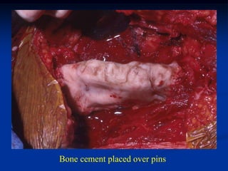 Bone cement placed over pins
 