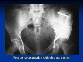 Post op reconstruction with pins and cement
 