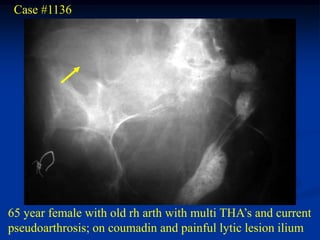 Case #1136




65 year female with old rh arth with multi THA’s and current
pseudoarthrosis; on coumadin and painful lytic lesion ilium
 