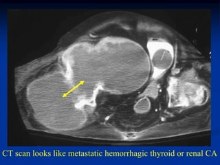 CT scan looks like metastatic hemorrhagic thyroid or renal CA
 