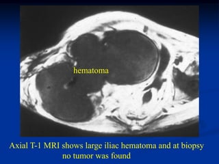 hematoma




Axial T-1 MRI shows large iliac hematoma and at biopsy
              no tumor was found
 