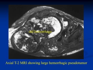 old hemorrhage




Axial T-2 MRI showing large hemorrhagic pseudotumor
 