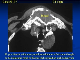 Case #1137                                   CT scan



                                   blood




 91 year female with aneurysmal pseudotumor of sternum thought
 to be metastatic renal or thyroid met; instead an aortic aneurysm
 