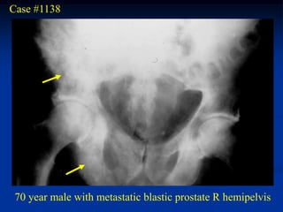 Case #1138




 70 year male with metastatic blastic prostate R hemipelvis
 