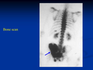Bone scan
 