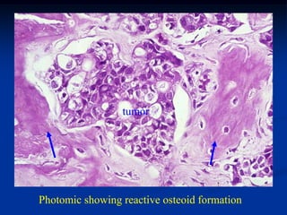 tumor




Photomic showing reactive osteoid formation
 