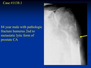Case #1138.1




84 year male with pathologic
fracture humerus 2nd to
metastatic lytic form of
prostate CA
 