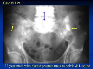 Case #1139




72 year male with blastic prostate mets to pelvis & L-spine
 
