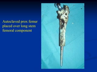 Autoclaved prox femur
placed over long stem
femoral component
 