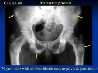 Case #1140              Metastatic prostate




79 year male with painless blastic mets to pelvis & prox femur
 