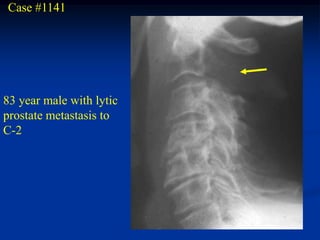 Case #1141




83 year male with lytic
prostate metastasis to
C-2
 
