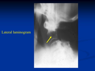 Lateral laminogram
 